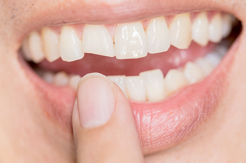 欠損歯の治療の特徴